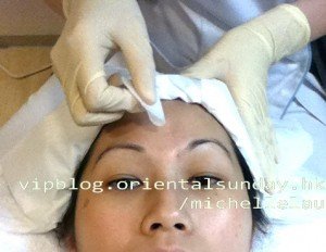 生平第一次的果酸煥膚1 