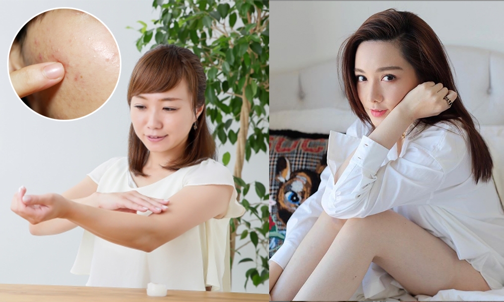 肌斷食護膚法日本大熱： 減少暗瘡、濕疹 突破護膚品停滯期！ 網民：好似換了張臉