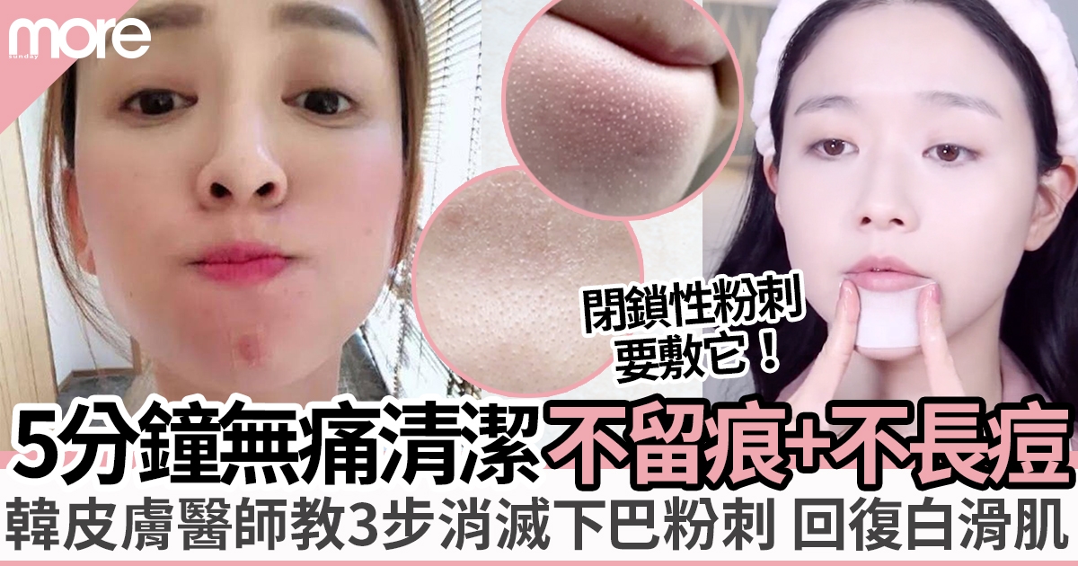 韓國皮膚醫師教消滅下巴粉刺只需3步！無痛清潔不留痕、不長痘