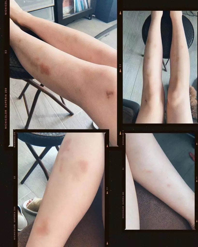 港姐2022 林鈺洧 林卓錡為參加探靈真人騷《鬼同你上位》而搞到雙腳撞瘀，網民留言話好心痛。