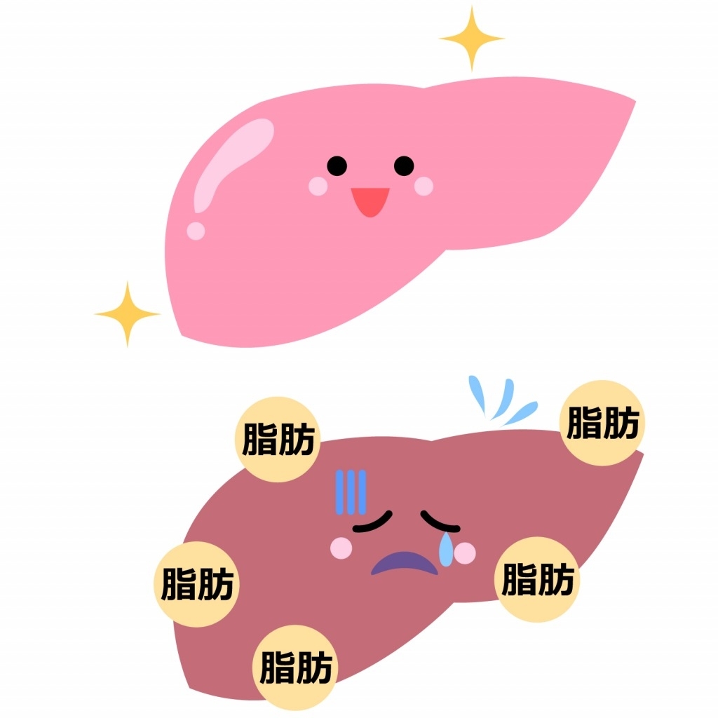 脂肪肝症狀 