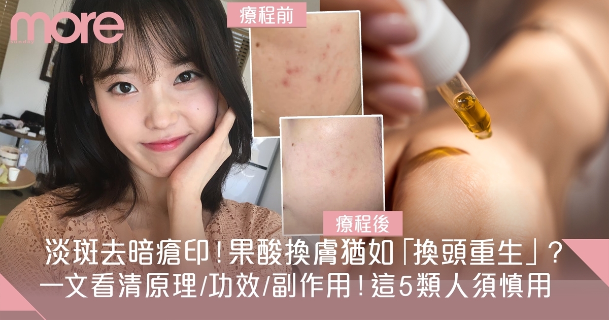 果酸換膚是什麼？療程後保養/功效/副作用一文看清
