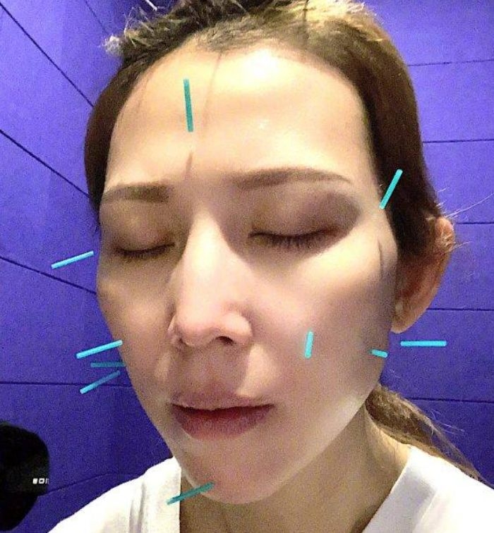 美顏針是甚麼？中醫美顏針灸蔡少芬也愛！刺激穴位自然瘦面、淡紋、改善暗沉
