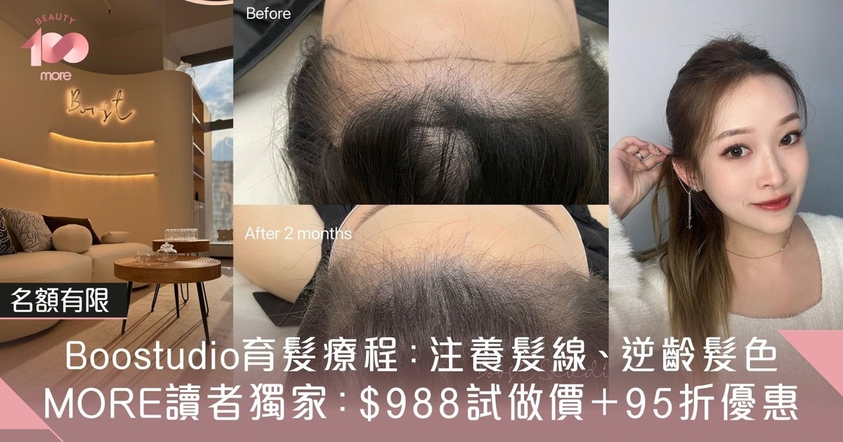 頭皮護理推薦2024｜10大療程+皮膚科醫生教正確洗頭方法[Beauty100]