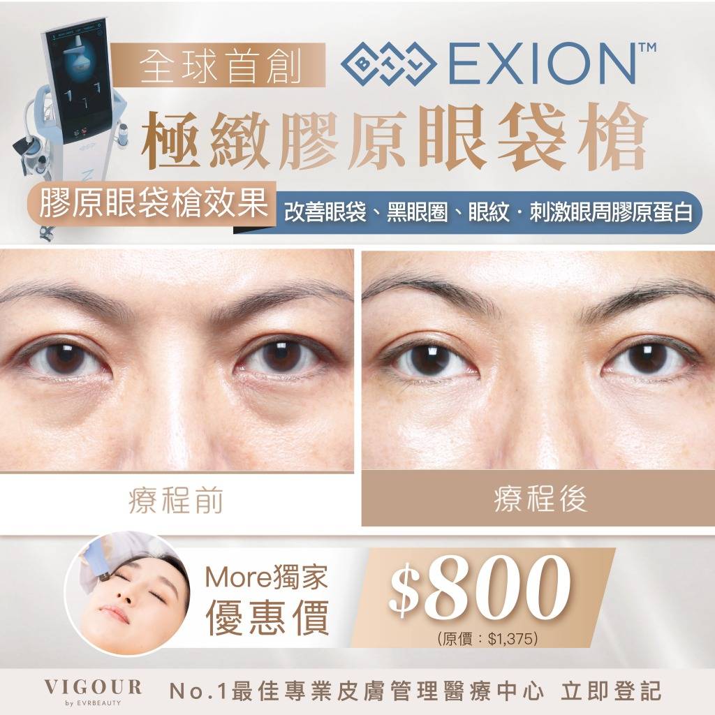 去眼袋 (圖片來源:VIGOUR by EVRbeauty)