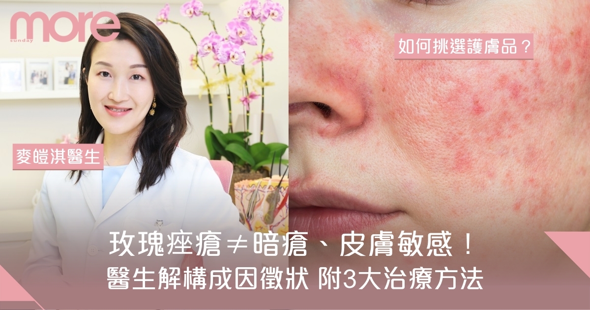 玫瑰痤瘡成因徵狀及治療方法！醫生：玫瑰痤瘡不等於暗瘡/紅斑狼瘡/皮膚敏感