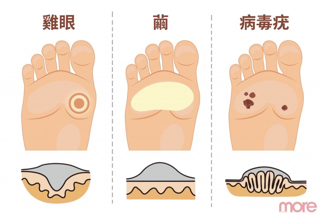 雞眼 雞眼、繭、病毒疣(圖片來源:MORE製圖)
