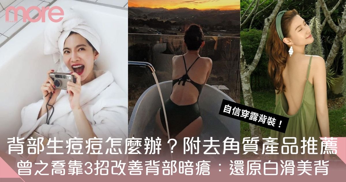 背部暗瘡護理：6大成因及去暗瘡產品推薦！曾之喬3招變回白滑肌