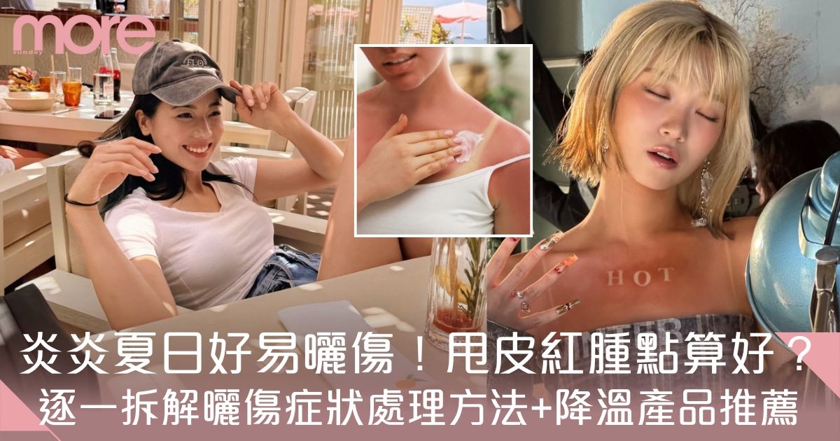 曬傷處理｜曬傷甩皮紅腫痕癢刺痛怎麼辦？12款曬後紓緩保濕美白推薦