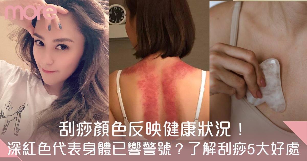 刮痧顏色反映健康狀況：深紅色、紫紅色代表甚麼？了解刮痧好處+正確方法
