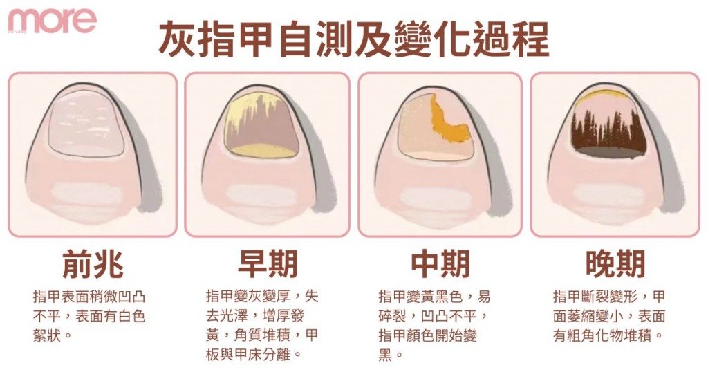 灰甲 (圖片來源:Canva)