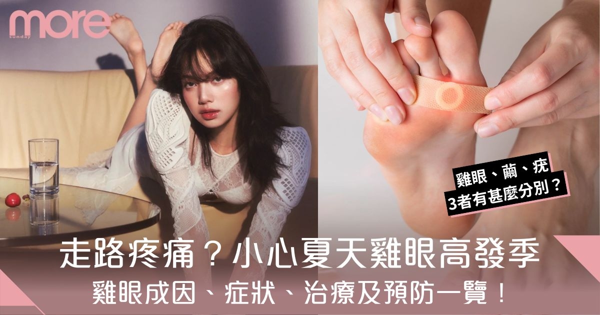 雞眼成因、症狀、治療及預防一覽！夏天高發季最易中招！附雞眼、繭、疣分別