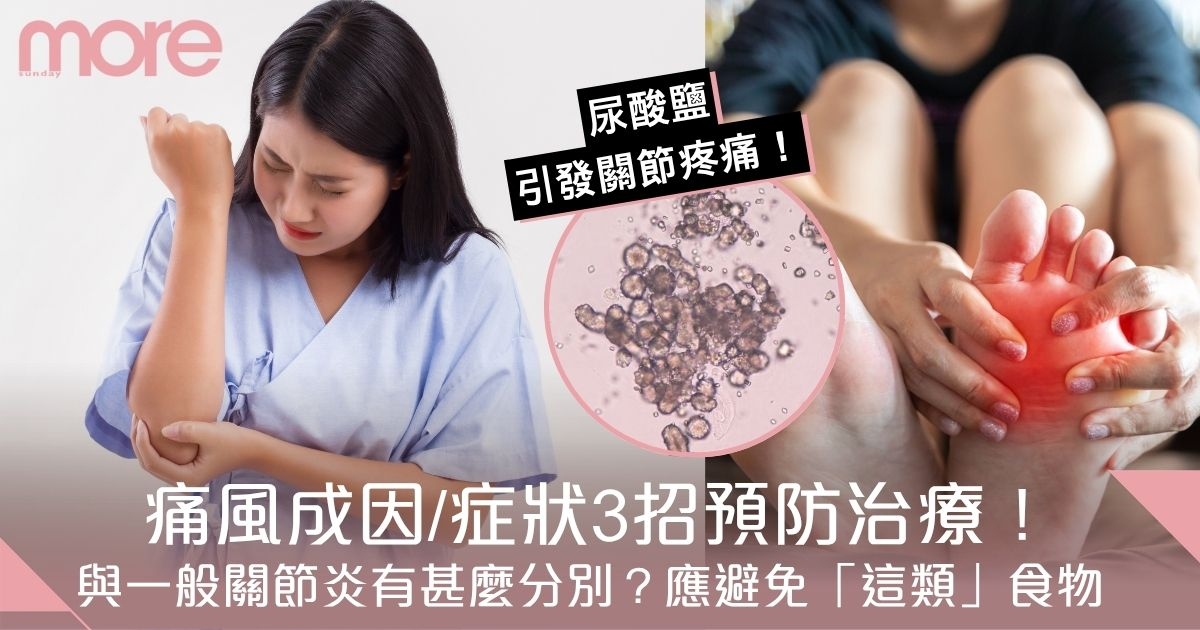 痛風成因、症狀一覽！痛風與一般關節炎有甚麼分別？3招預防治療