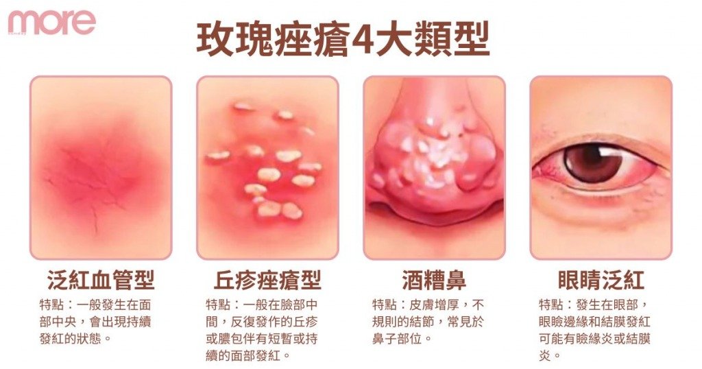 玫瑰痤瘡 (圖片來源:MORE製圖)
