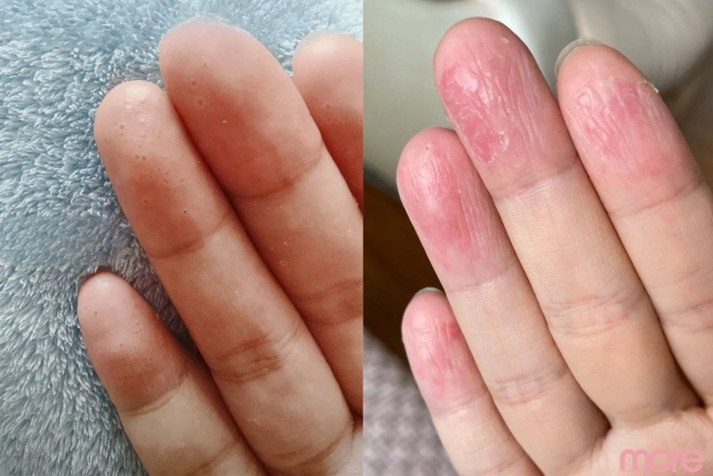 汗皰疹 左係汗皰疹的水泡形態,右為汗皰疹脫皮後的情況。(圖片來源:Echo Cheung攝)