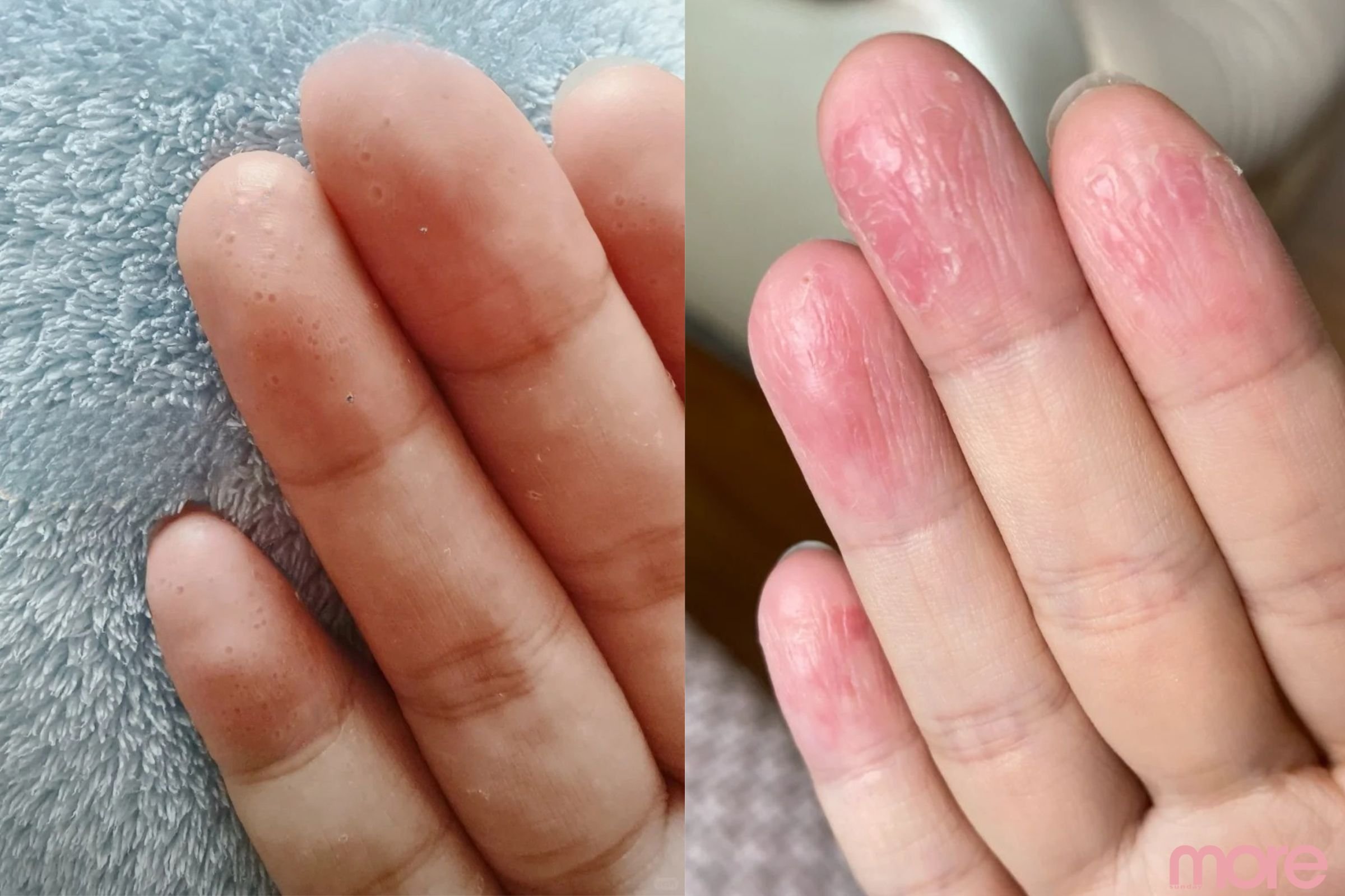 汗皰疹會自己好嗎？轉季皮膚痕癢/手指冒水泡或已中招！附6款汗皰疹藥膏推薦