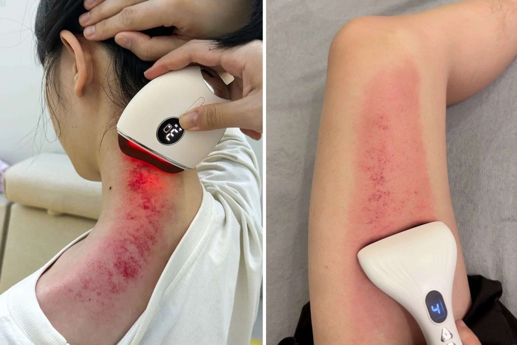 中醫去風 (圖片來源:RED@新奇站Newkiland、@90歲少年立志養生🌟)