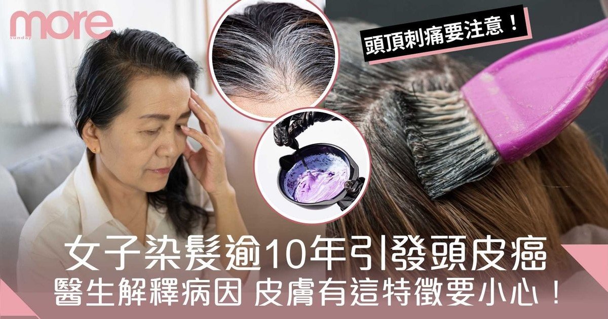內地女子染髮逾10年引發頭皮癌變  醫生解釋病因 皮膚有這特徵要小心！