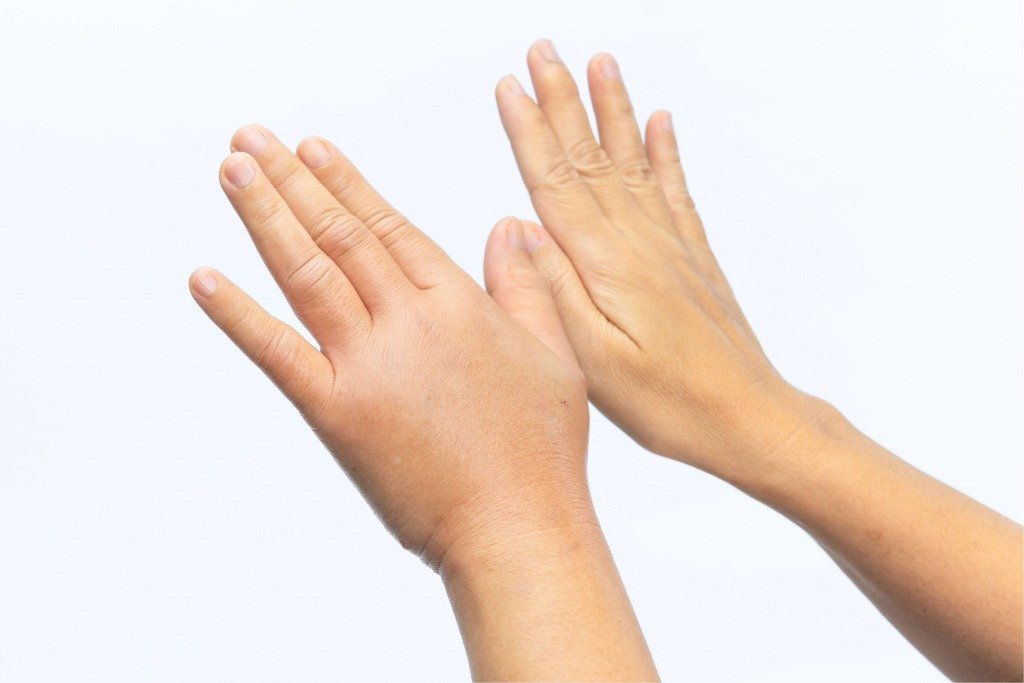 水腫 (圖片來源:Canva)