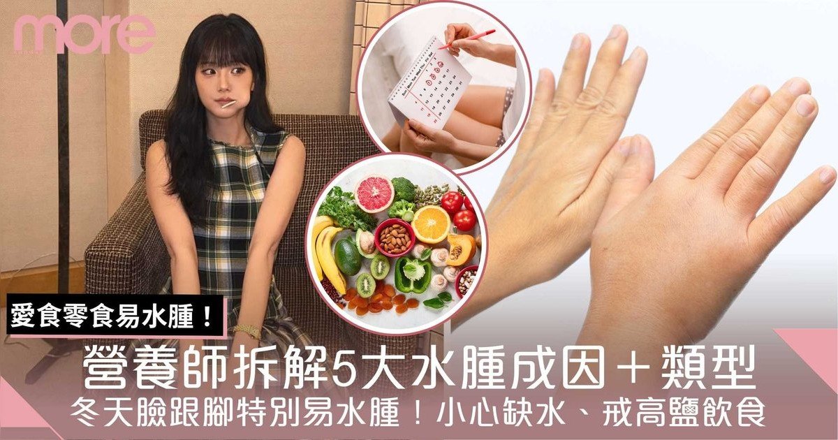 水腫5大成因＋類型｜ 營養師：冬天臉跟腳易水腫！缺水、月經前水腫