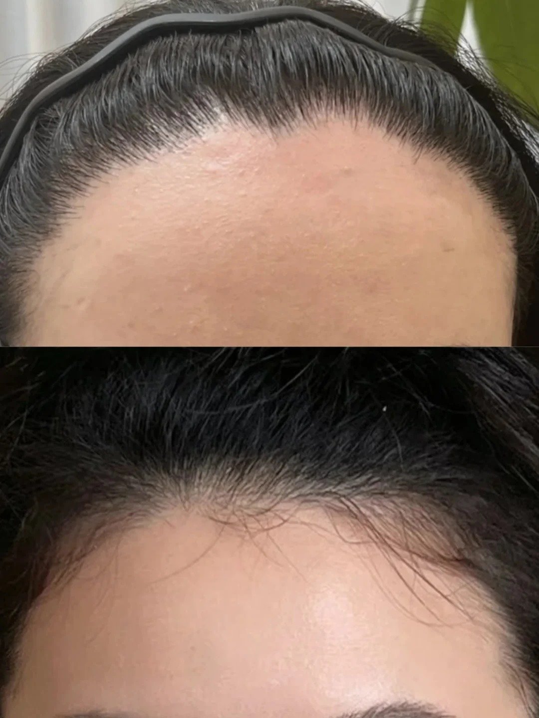 植髮是甚麼？小編實試透過頭髮移植 告別高髮際線/禿鬢角 2類人不宜