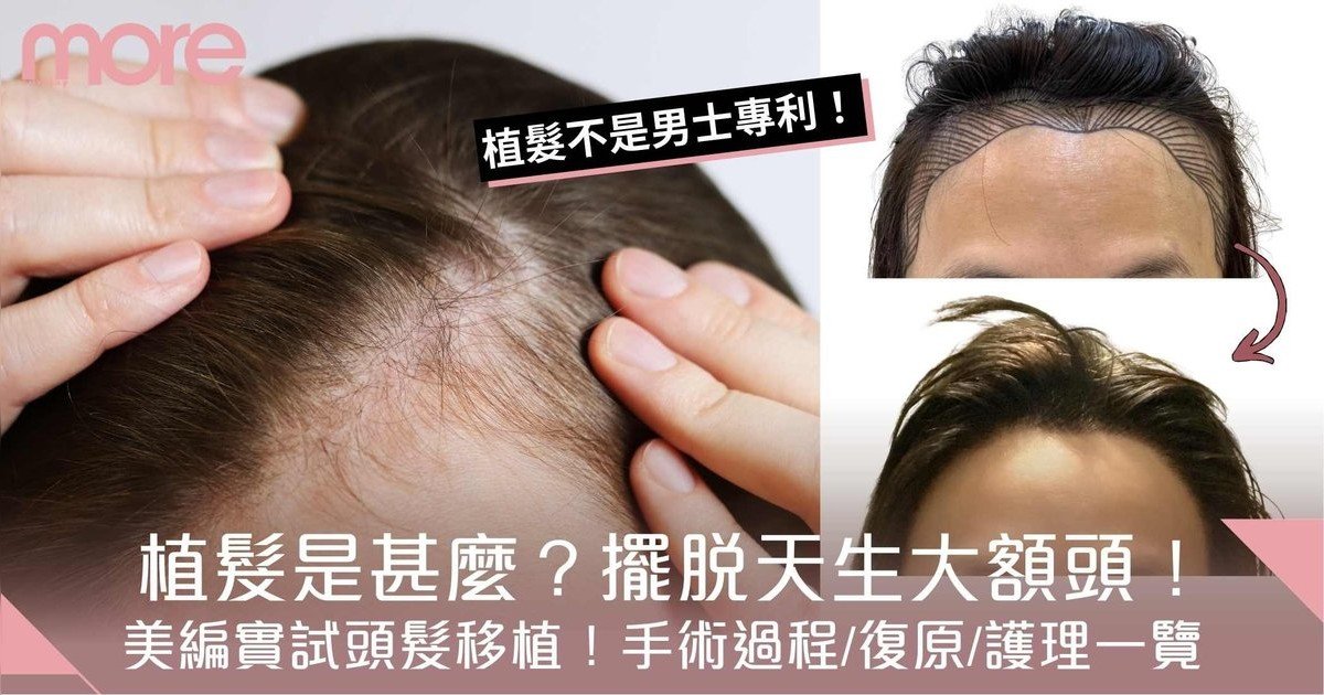 植髮是甚麼？小編實試透過頭髮移植 告別高髮際線/禿鬢角 2類人不宜