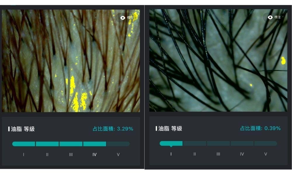 頭皮 7日油脂變化:油脂由等級4顯著下降至等級1**