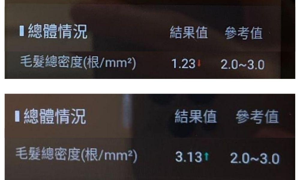 頭皮 28日頭髮濃密度變化:頭髮濃密度增加154.47%**