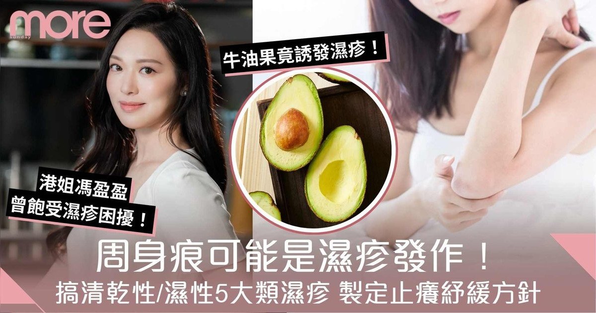 濕疹成因細數！搞清乾性/濕性5類濕疹+製定止癢紓緩方針！牛油果竟誘發濕疹