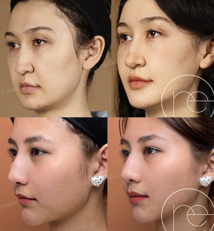A.I.科技遇上膠原美學！retens X Ellansé®少女針 以精準數據分析重塑「原生美」輪廓