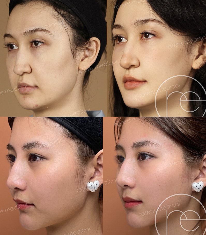 少女針 真實個案分享:Ellansé®少女針有別於傳統填充劑的「填滿感」,於深層組織更高韌性精準撐起下垂位,以及加固深層結構,帶來有飽滿感的「骨感美」,重塑自然而有個性的原生美輪廓!(圖片來源:retens)