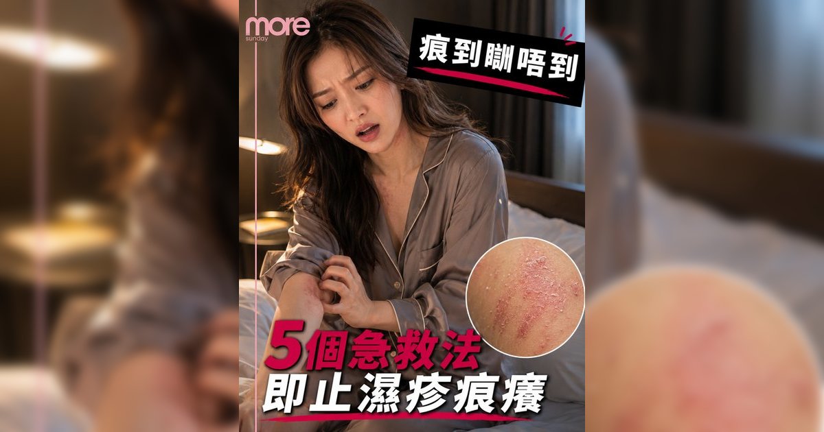 濕疹止痕｜醫生教5個急救法即時舒緩！必讀抗炎食物清單＋3大類戒口食物