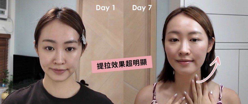 無針微調 只是7天,提拉效果超明顯之餘,法令紋明顯淡化,下顎線輪廓更清晰!(圖片來源:more)